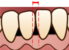 IPR (Interproximal enamel Reduction)