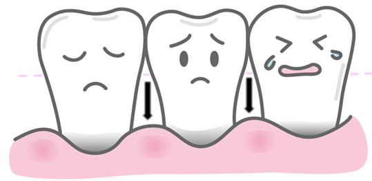 歯肉が下がる様子
