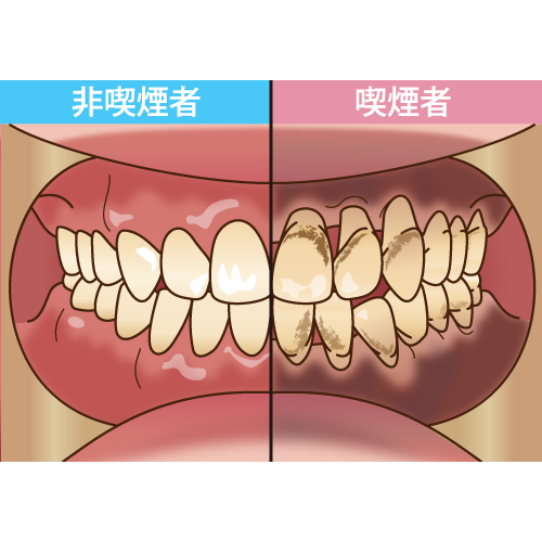 歯肉のメラニン色素沈着