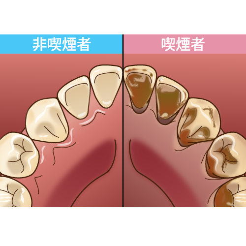 着色した歯