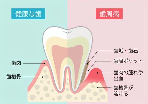 歯槽骨吸収、歯の喪失